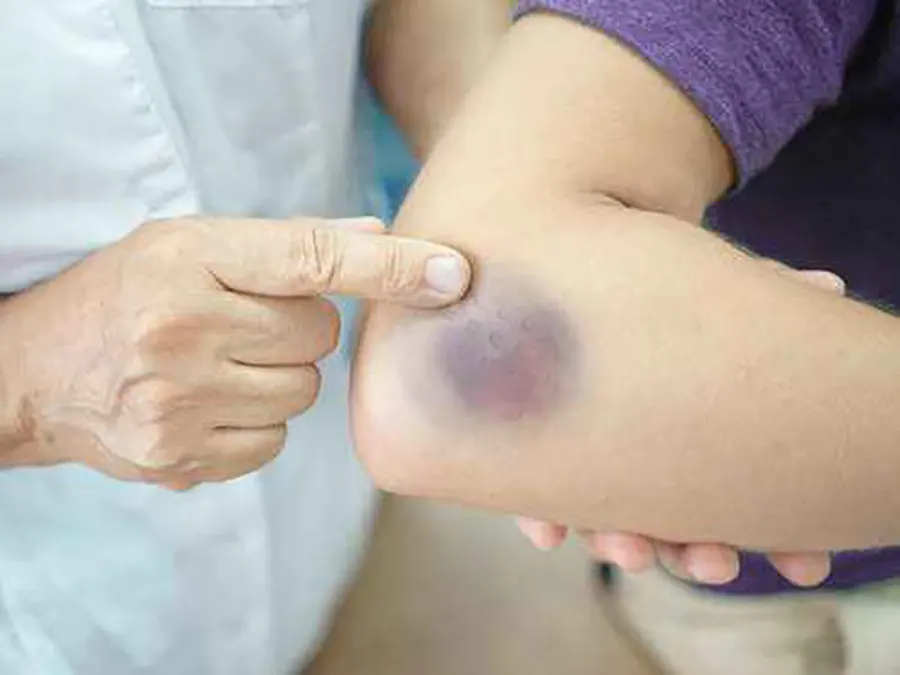طب سوزنی چیست و چگونه انجام میشود؟ — هر آنچه باید بدانید 10 طب سوزنی چیست و چگونه انجام میشود؟