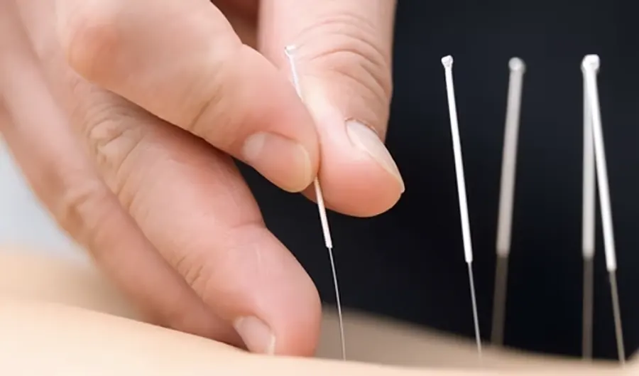 طب سوزنی چیست و چگونه انجام میشود؟ — هر آنچه باید بدانید 5 طب سوزنی چیست و چگونه انجام میشود؟